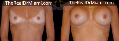 Before-and-after views for Breast Augmentation, Case 117.