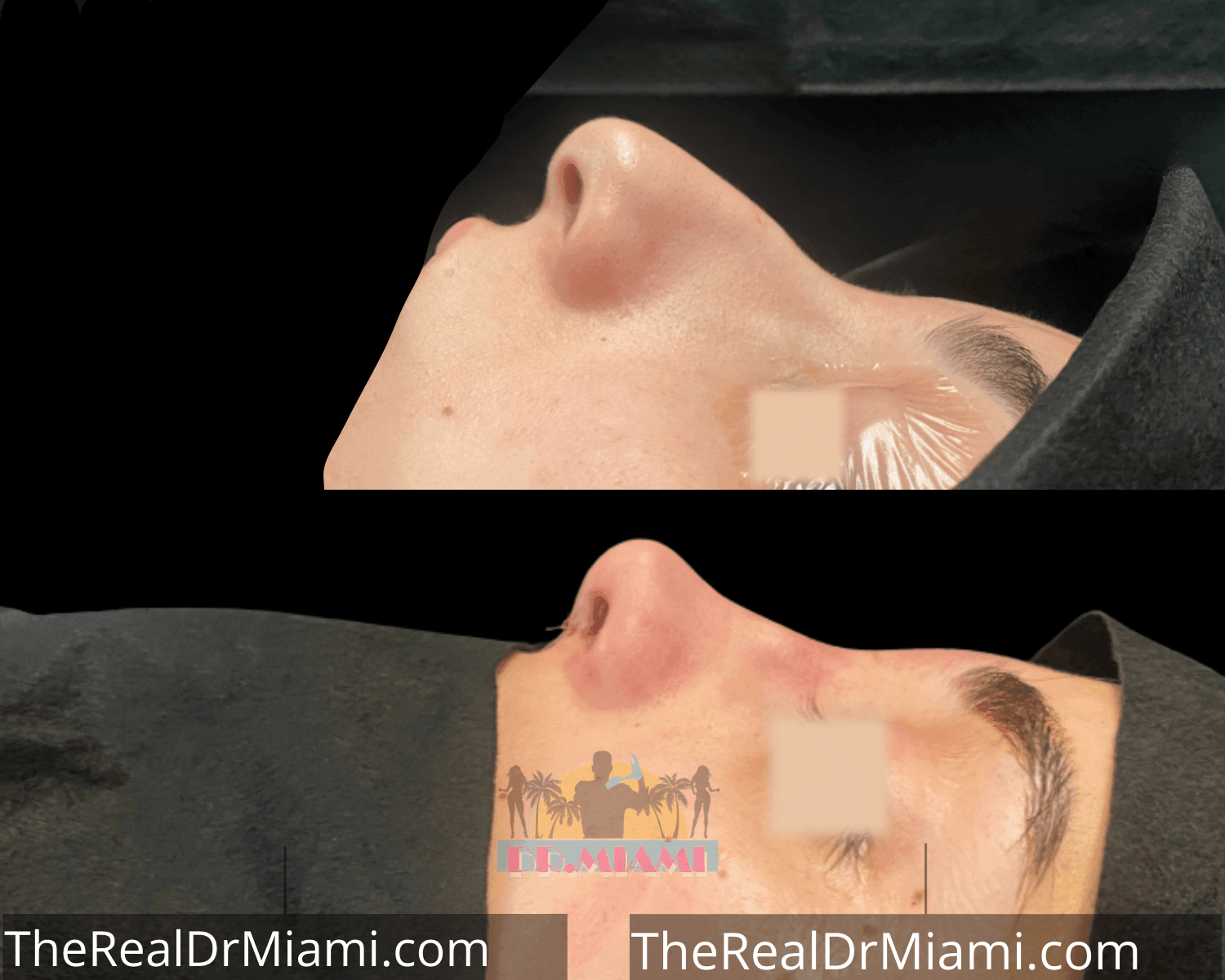 Before-and-after views for Rhinoplasty, Case 21.