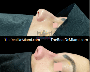 Before-and-after views for Rhinoplasty, Case 112.
