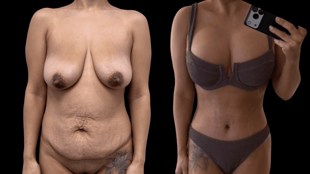 Before-and-after views for Mommy Makeover, Case 3 from The Next Dr. Miami collection.