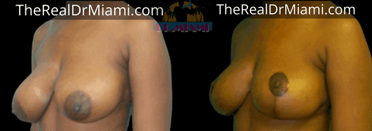 Before-and-after views for Breast Lift, Case 24.