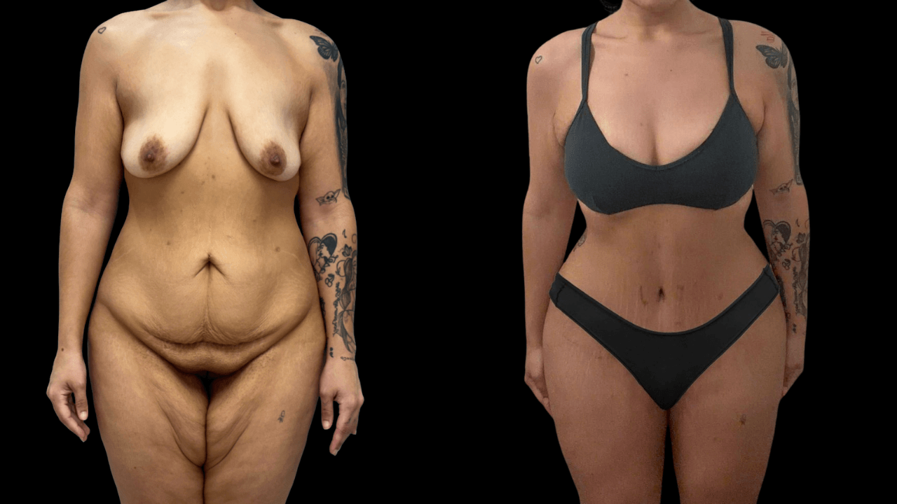 Before-and-after views for Mommy Makeover, Case 2 from The Next Dr. Miami collection.