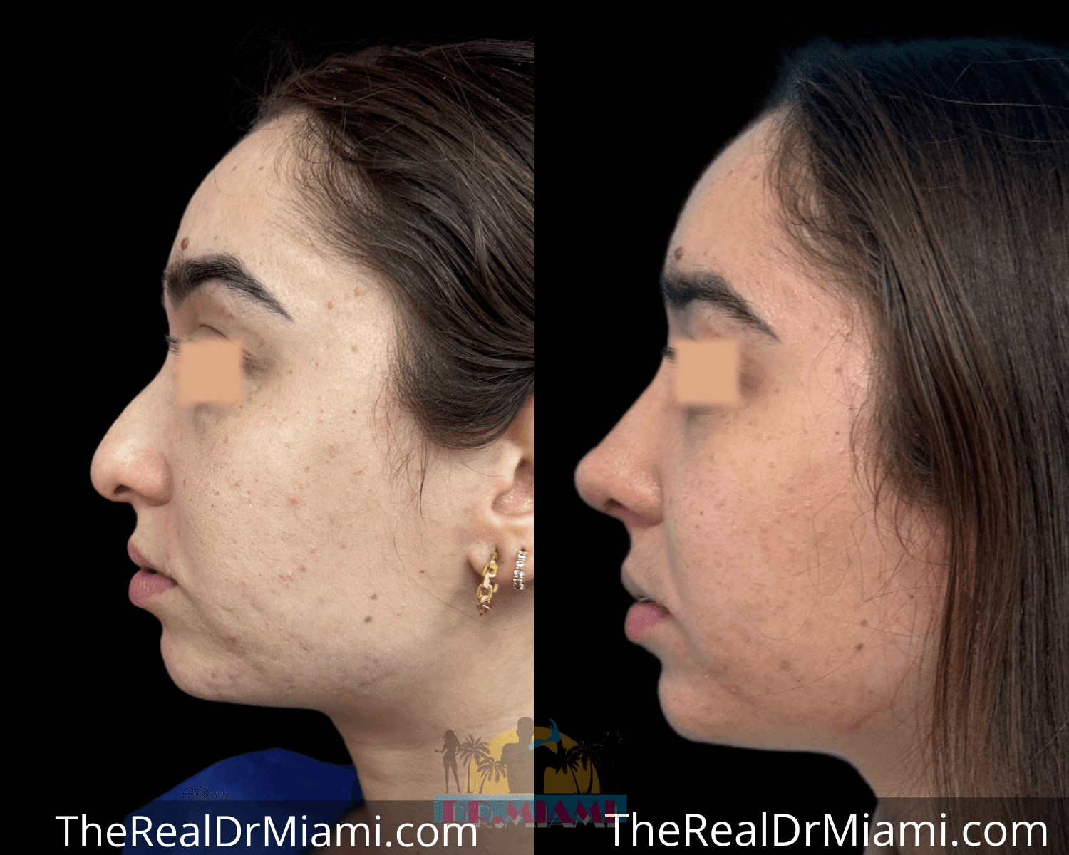 Before-and-after views for Rhinoplasty, Case 1.