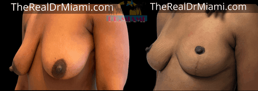 Before-and-after views for Breast Lift, Case 95.