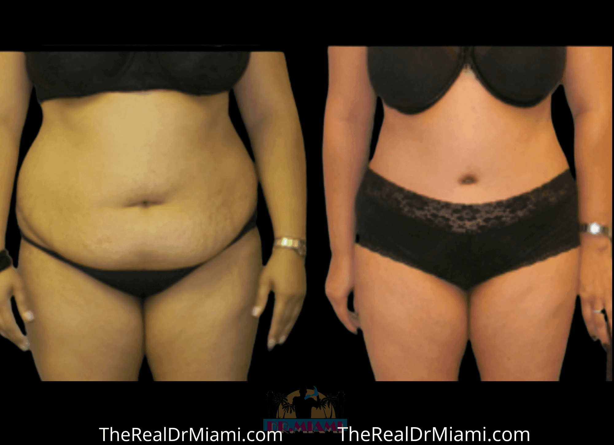 Before-and-after views for Tummy Tuck, Case 90.