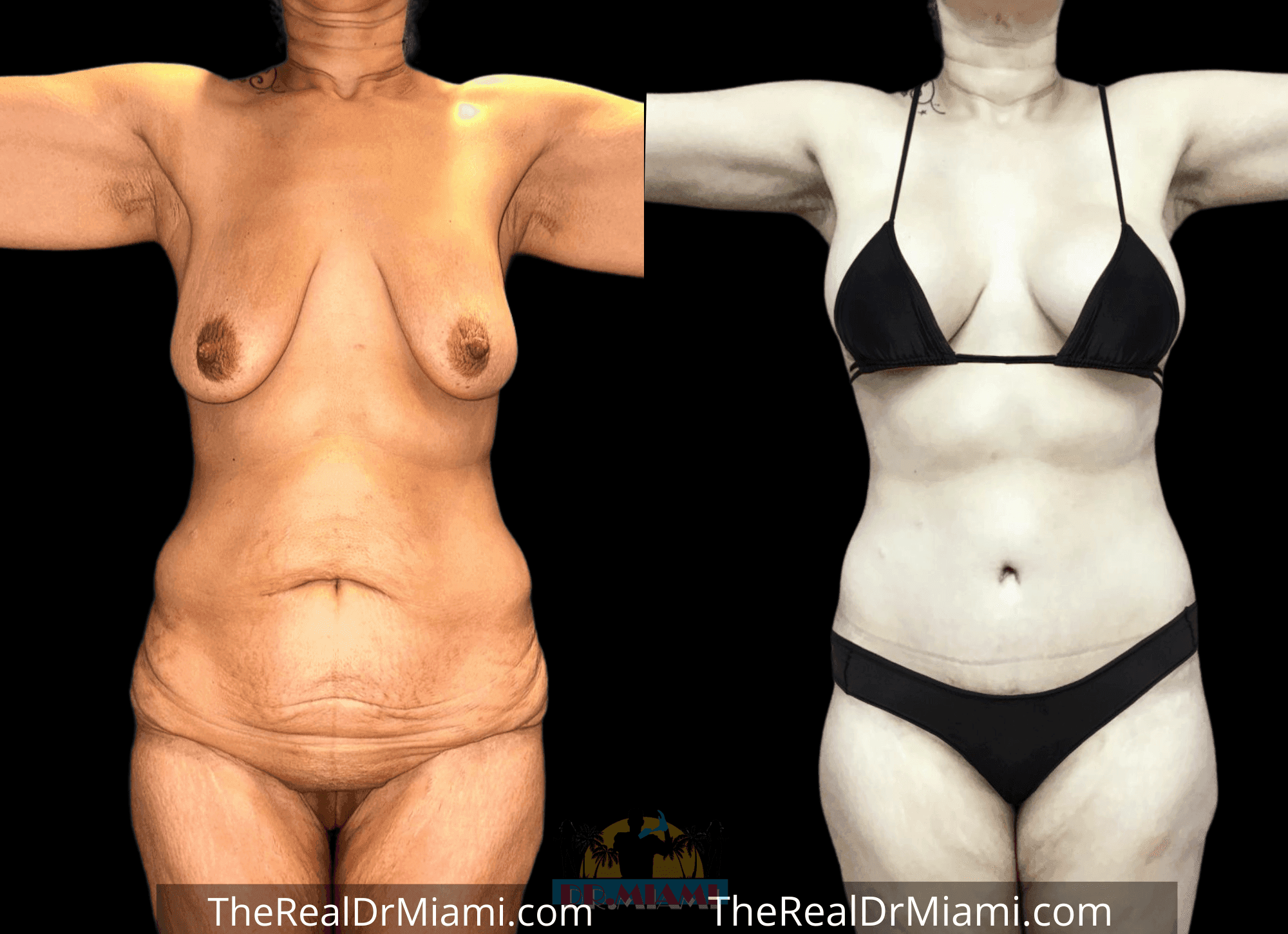 Before-and-after views for Mommy Makeover, Case 86.