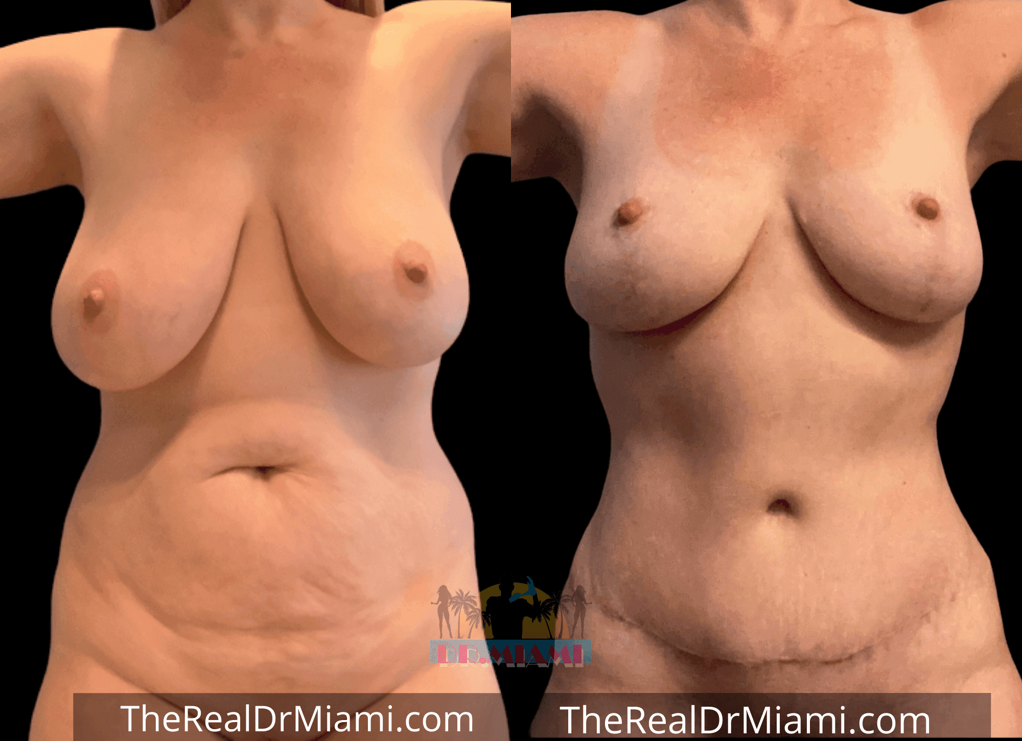 Before-and-after views for Mommy Makeover, Case 39.