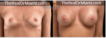 Before-and-after views for Breast Augmentation, Case 35.