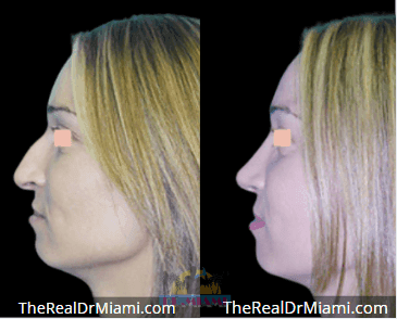 Before-and-after views for Rhinoplasty, Case 89.