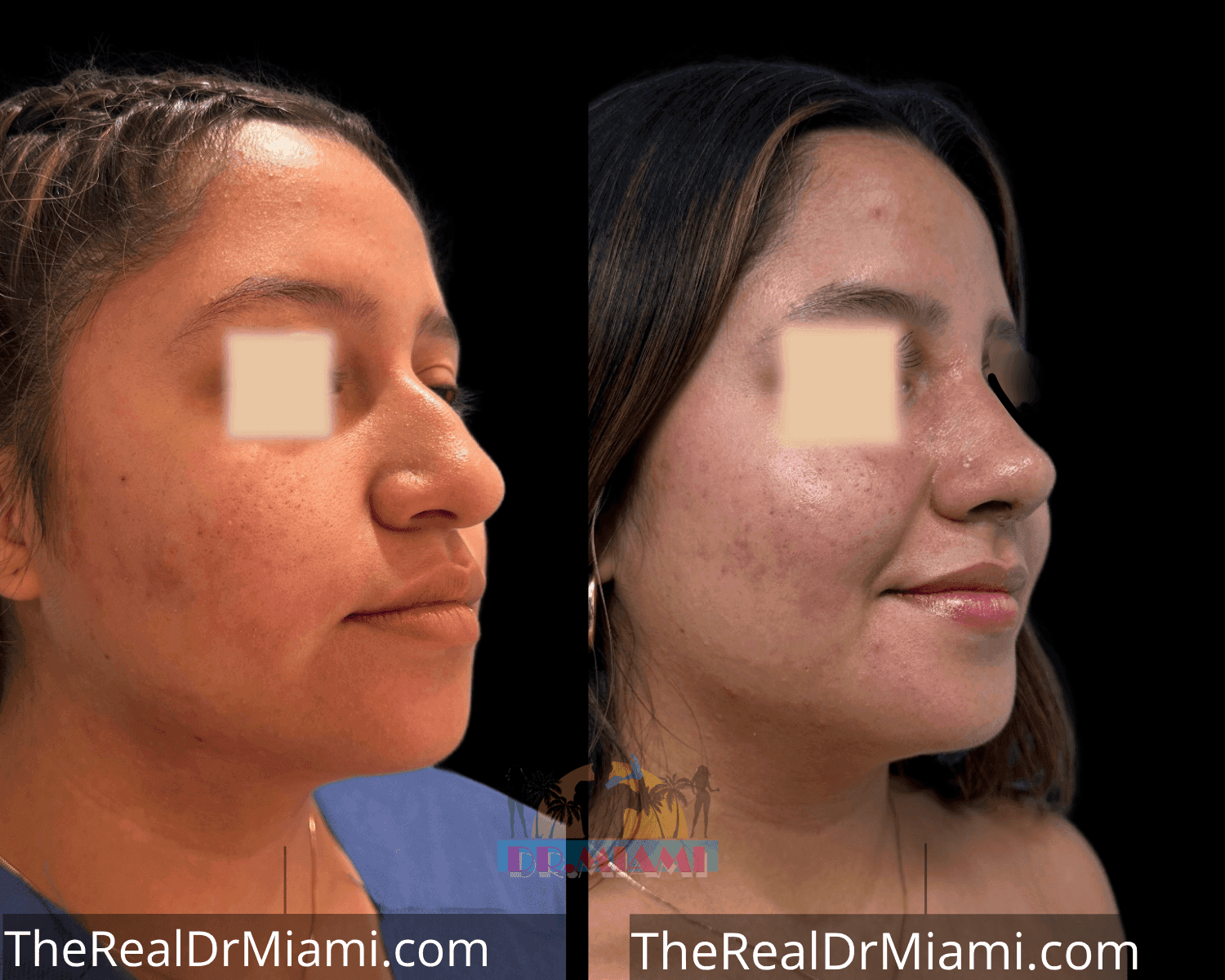 Before-and-after views for Rhinoplasty, Case 6.