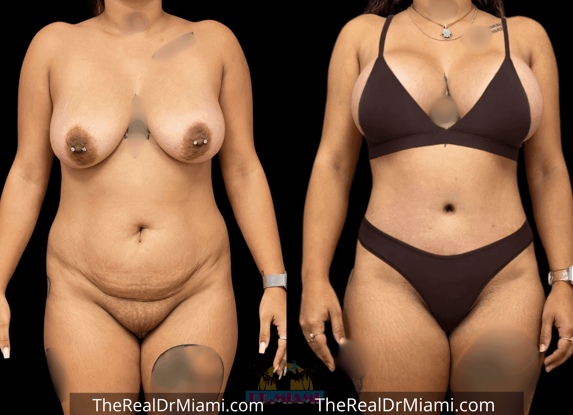 Before-and-after views for Mommy Makeover, Case 73.