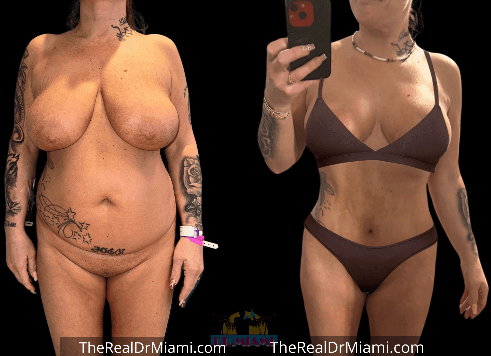 Before-and-after views for Tummy Tuck, Case 44.
