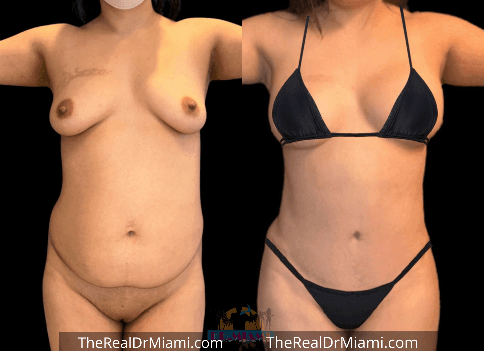 Before-and-after views for Mommy Makeover, Case 99.