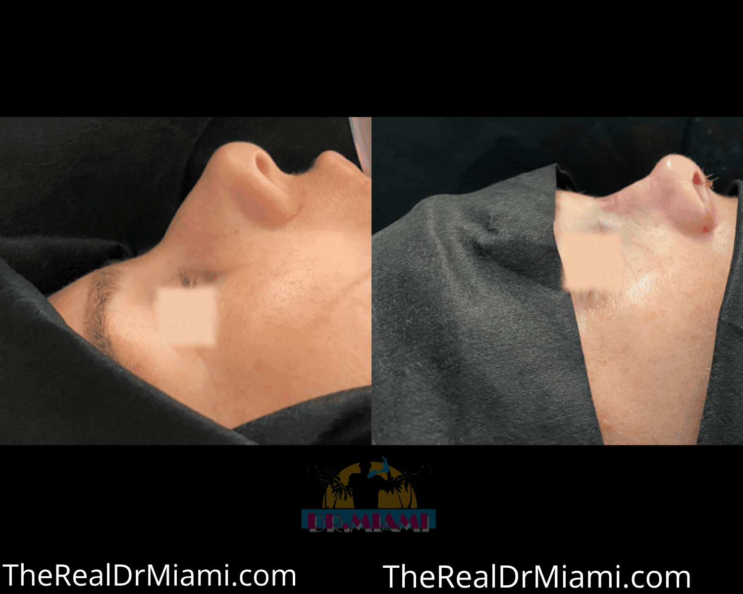 Before-and-after views for Rhinoplasty, Case 33.