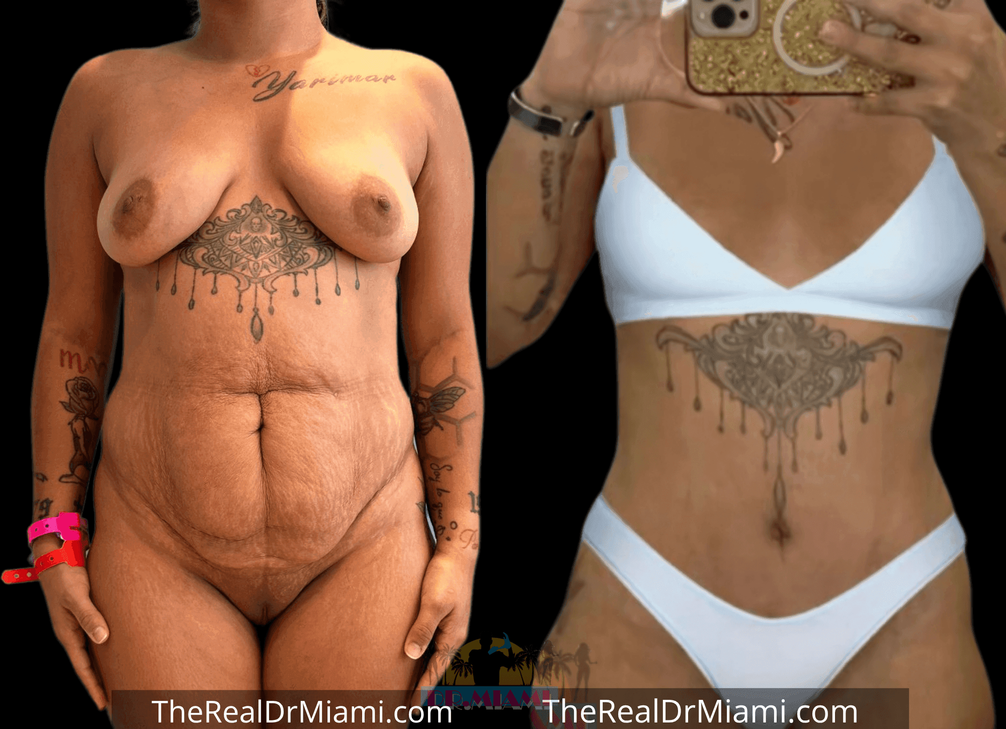 Before-and-after views for Tummy Tuck, Case 101.