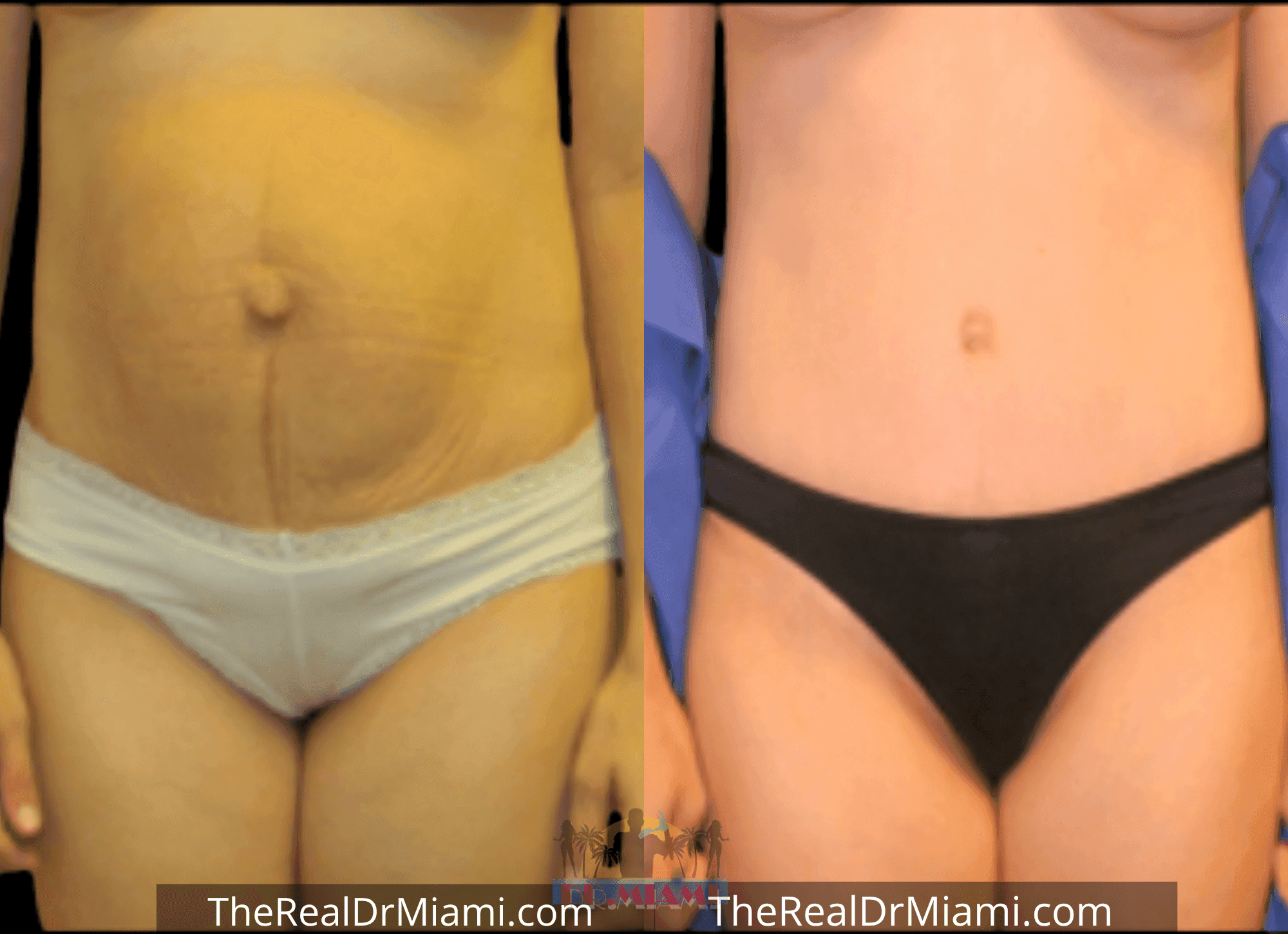 Before-and-after views for Tummy Tuck, Case 77.