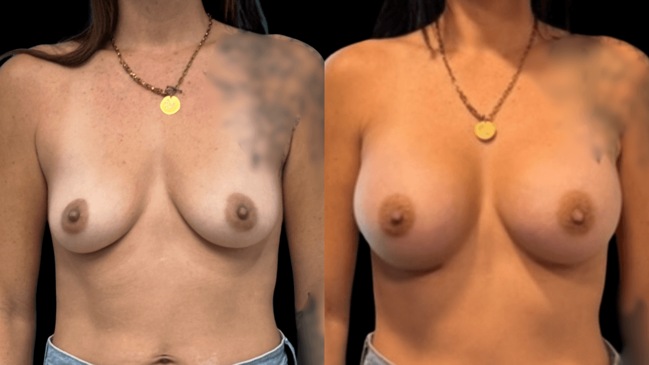 Before-and-after views for Breast Augmentation / Lift, Case 1 from The Next Dr. Miami collection.