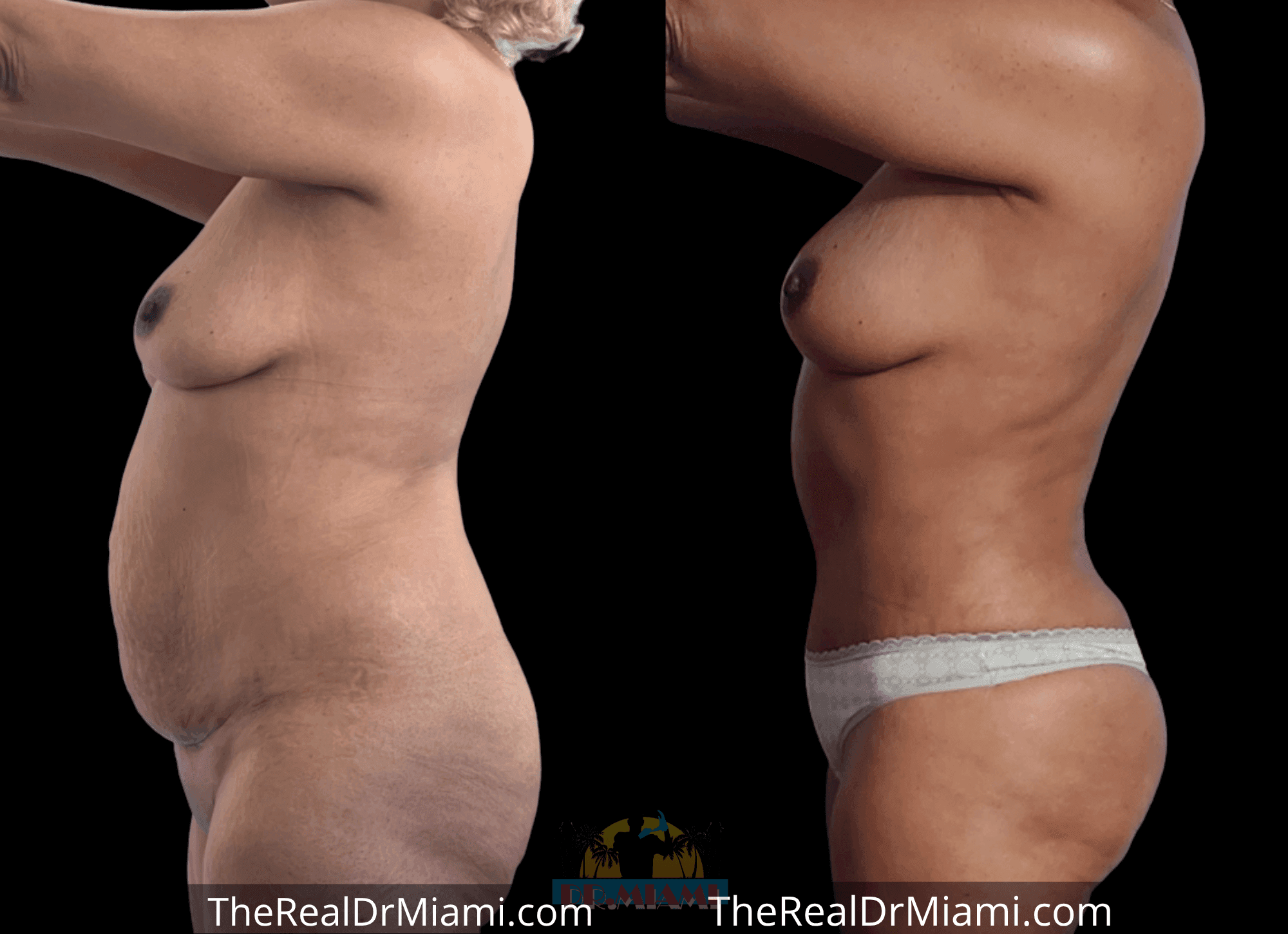 Before-and-after views for Tummy Tuck, Case 24.