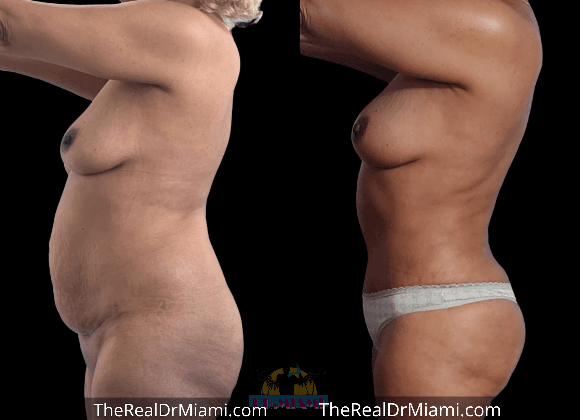 Before-and-after views for Tummy Tuck, Case 24.
