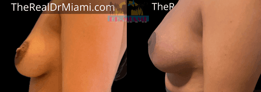 Before-and-after views for Breast Lift, Case 96.