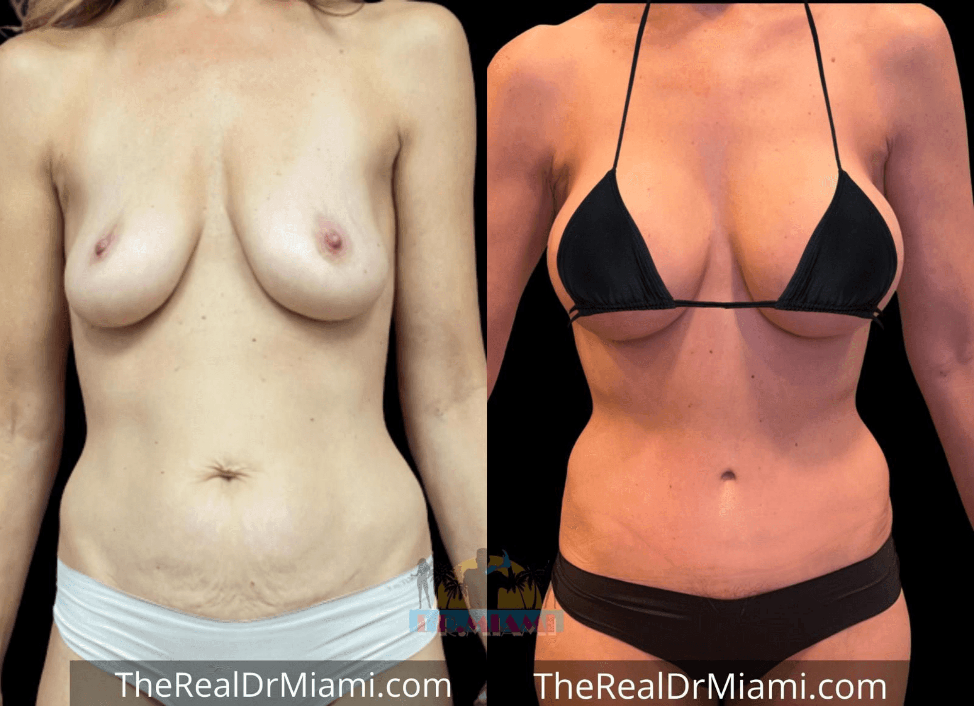 Before-and-after views for Mommy Makeover, Case 8.