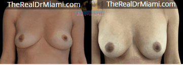 Before-and-after views for Breast Augmentation, Case 34.