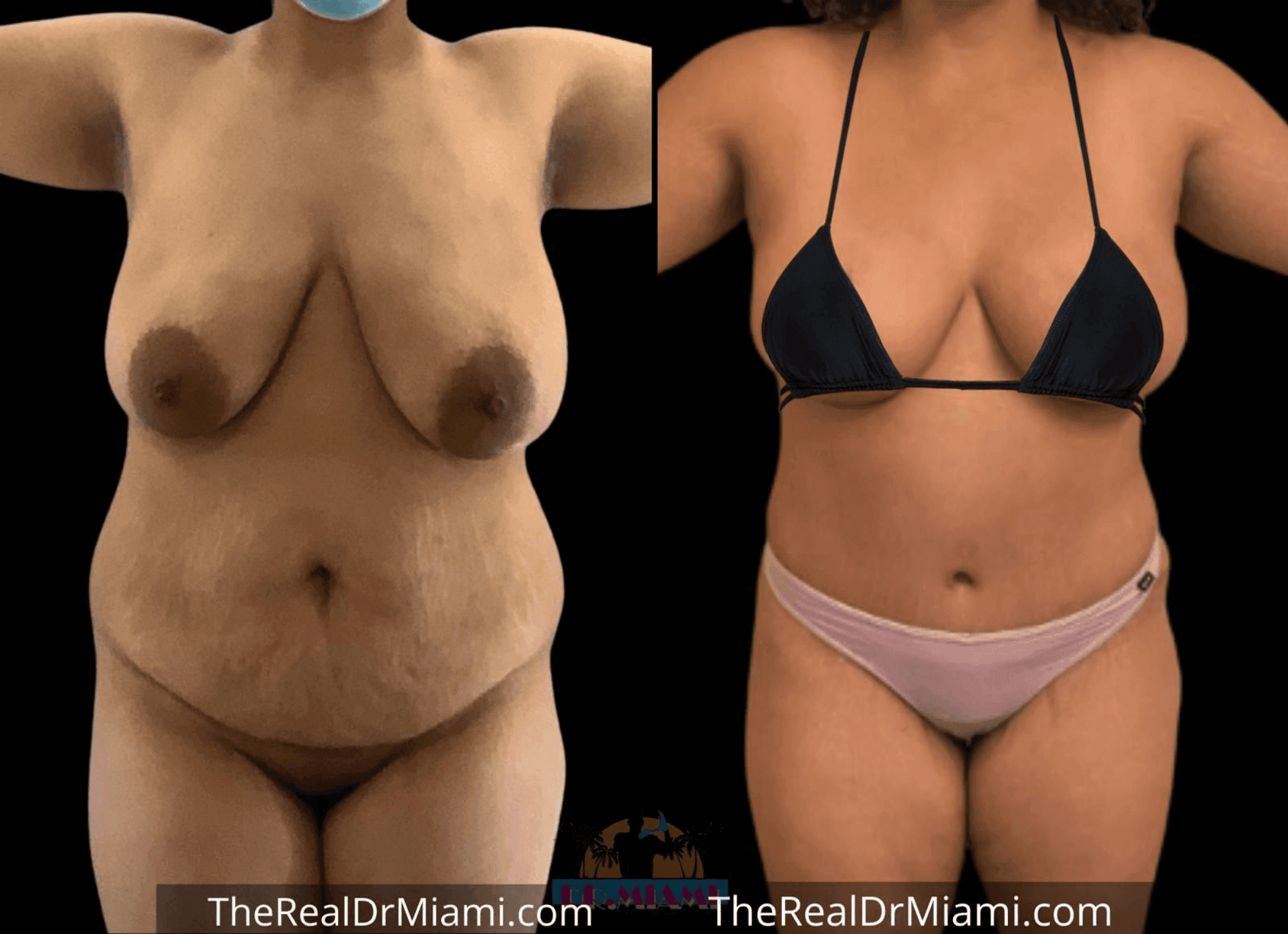 Before-and-after views for Tummy Tuck, Case 25.