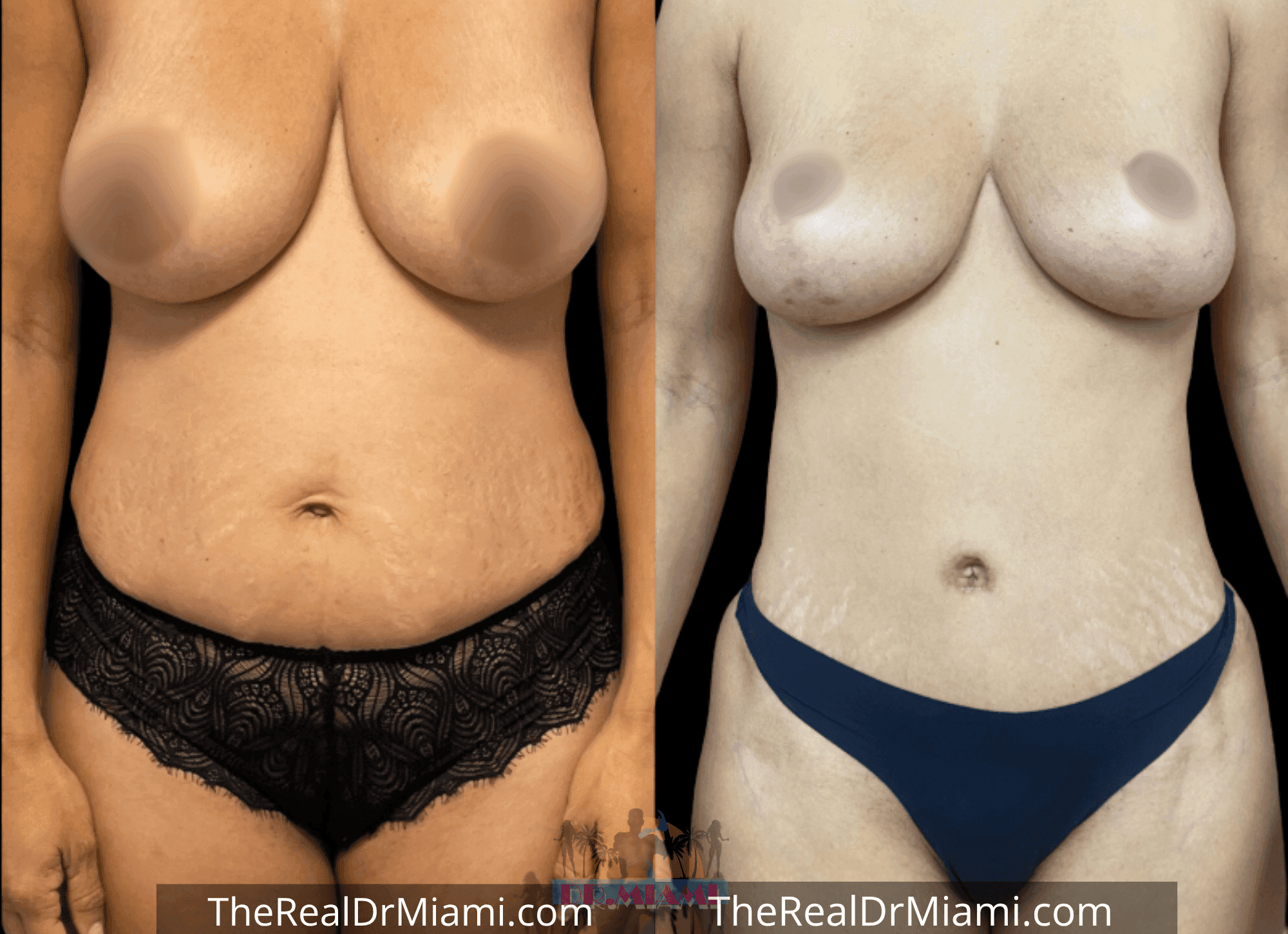 Before-and-after views for Tummy Tuck, Case 100.