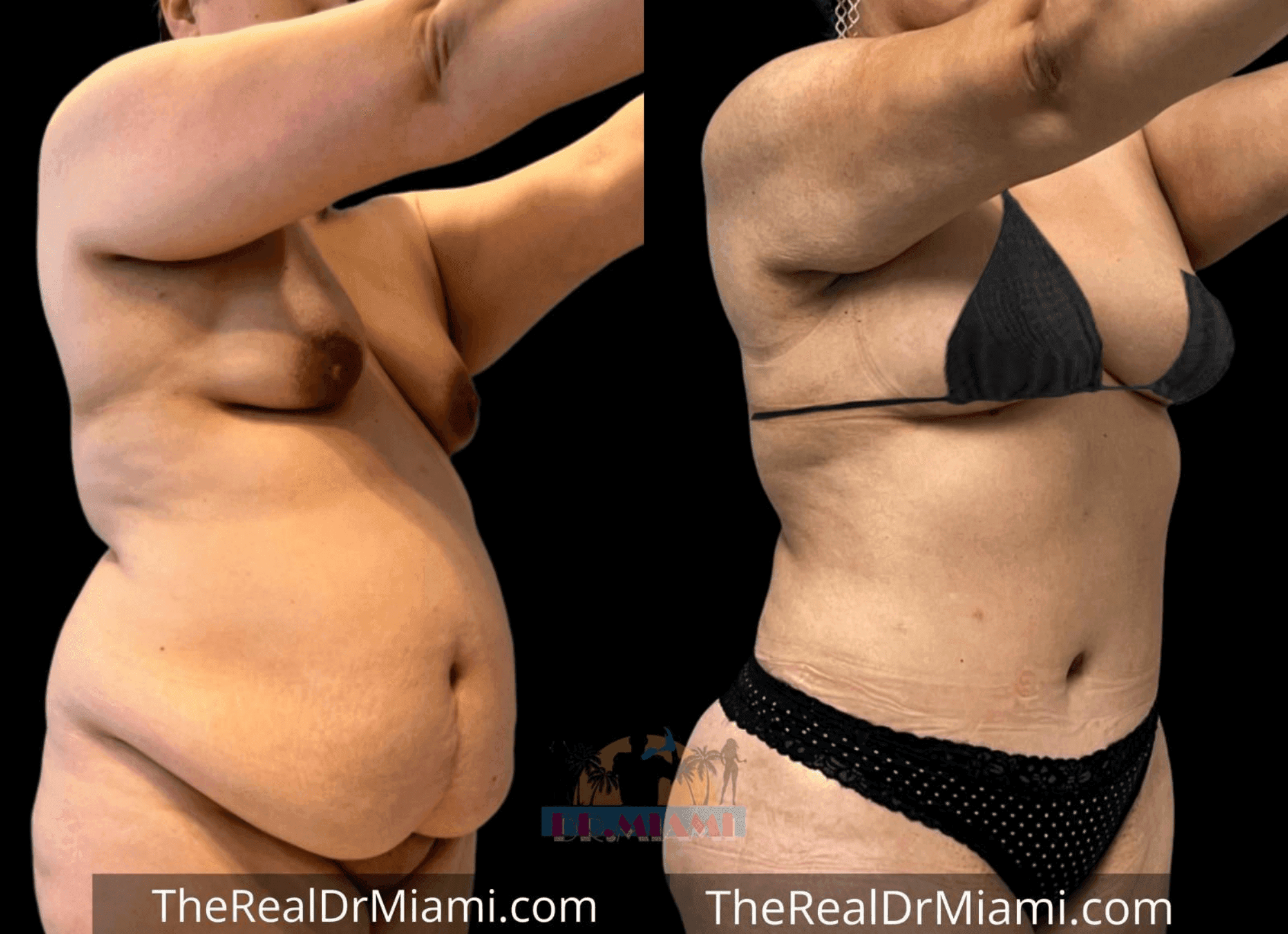 Before-and-after views for Mommy Makeover, Case 48.