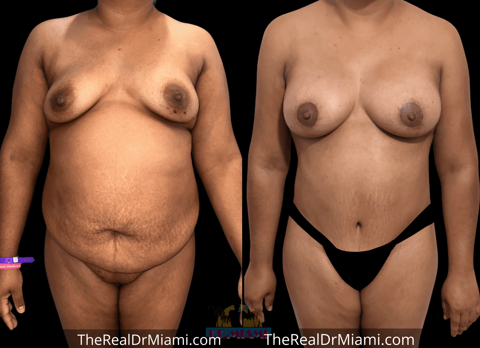 Before-and-after views for Mommy Makeover, Case 114.
