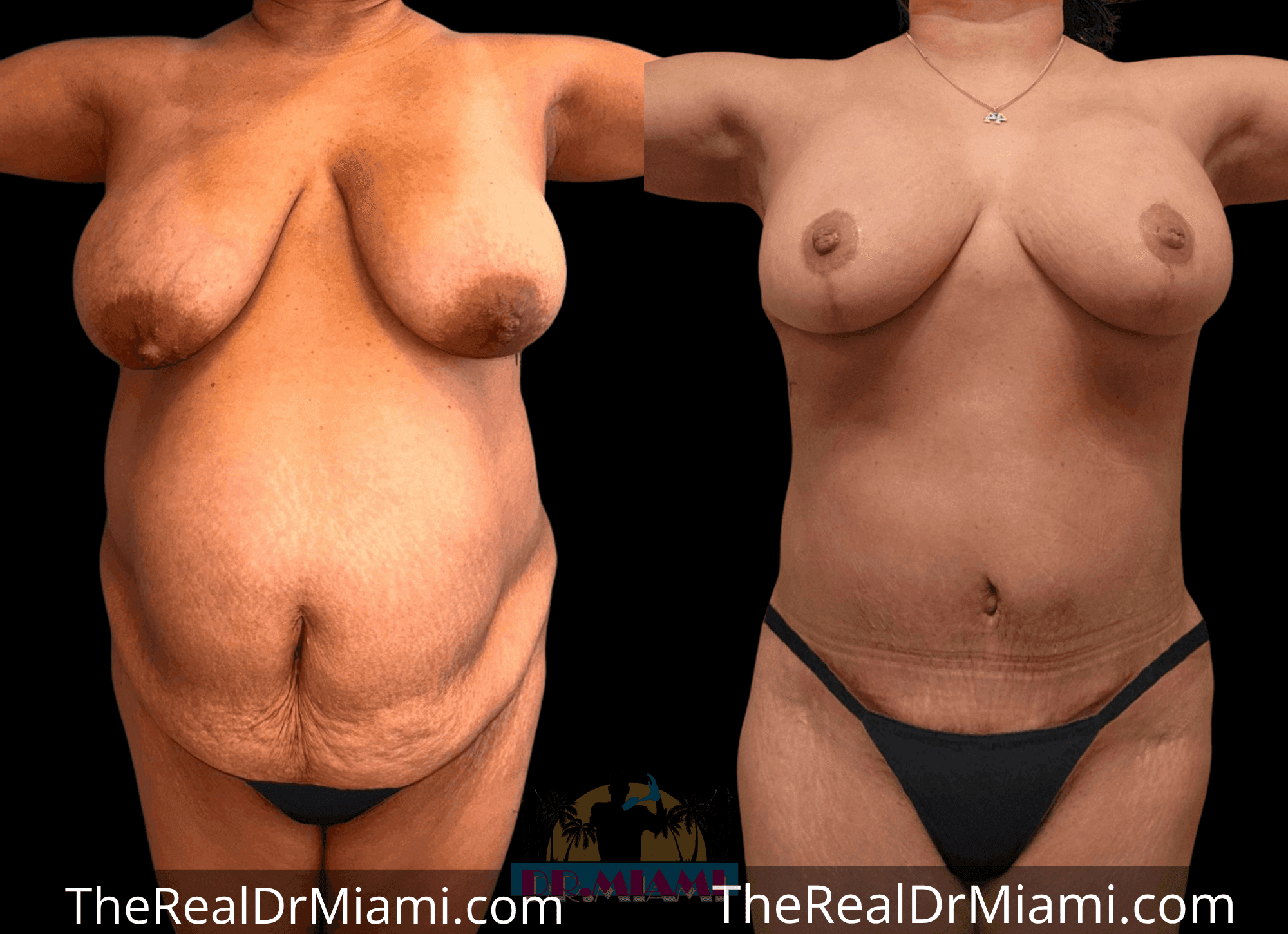 Before-and-after views for Massive Weight Loss, Case 10.