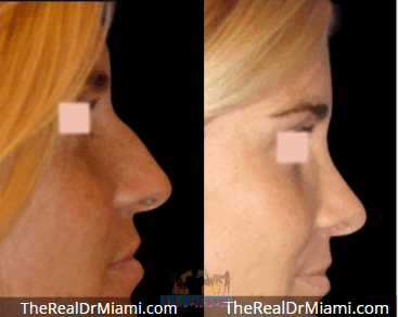 Before-and-after views for Rhinoplasty, Case 99.