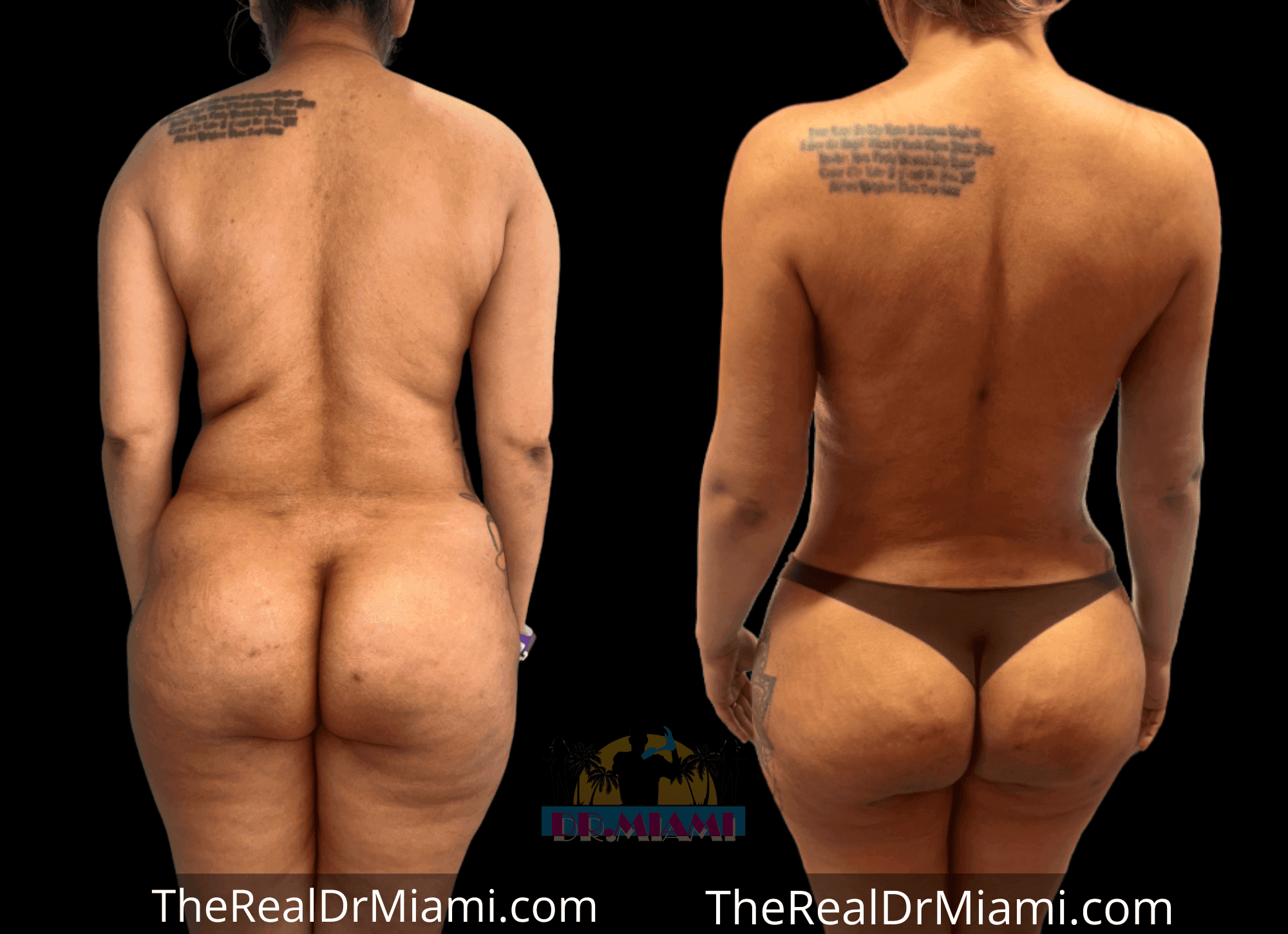 Before-and-after views for Brazilian Butt Lift, Case 25.
