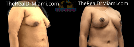 Before-and-after views for Breast Lift, Case 57.