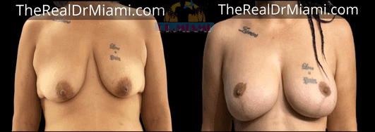 Before-and-after views for Breast Lift, Case 56.
