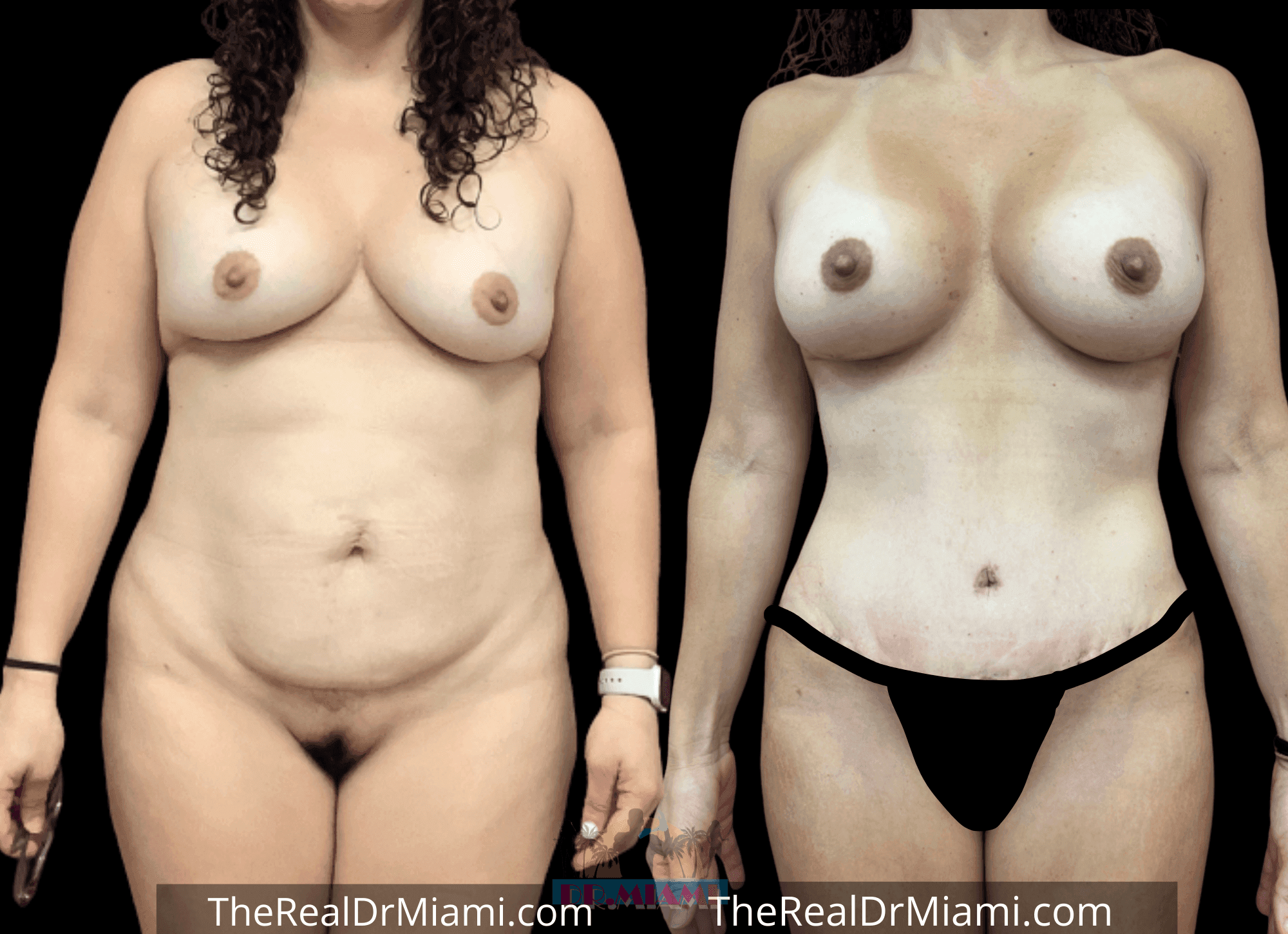Before-and-after views for Tummy Tuck, Case 109.