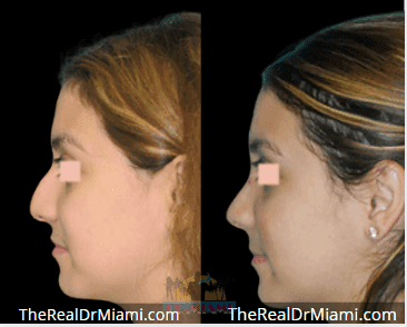 Before-and-after views for Rhinoplasty, Case 93.