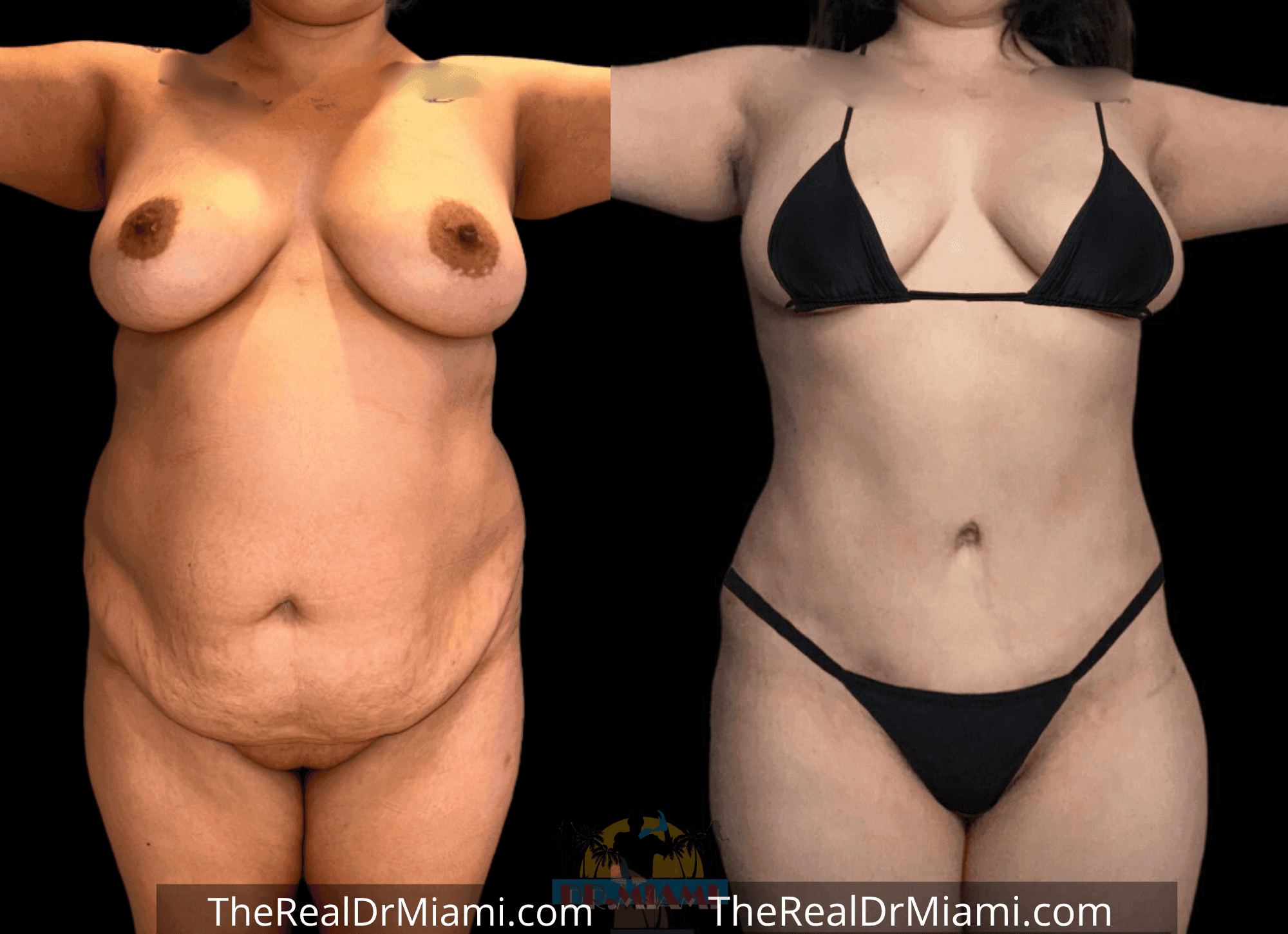 Before-and-after views for Tummy Tuck, Case 5.