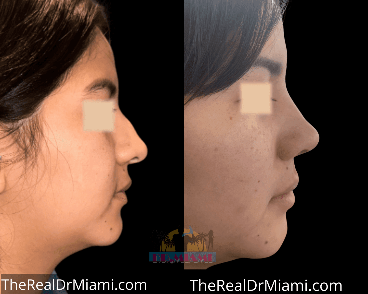 Before-and-after views for Rhinoplasty, Case 45.