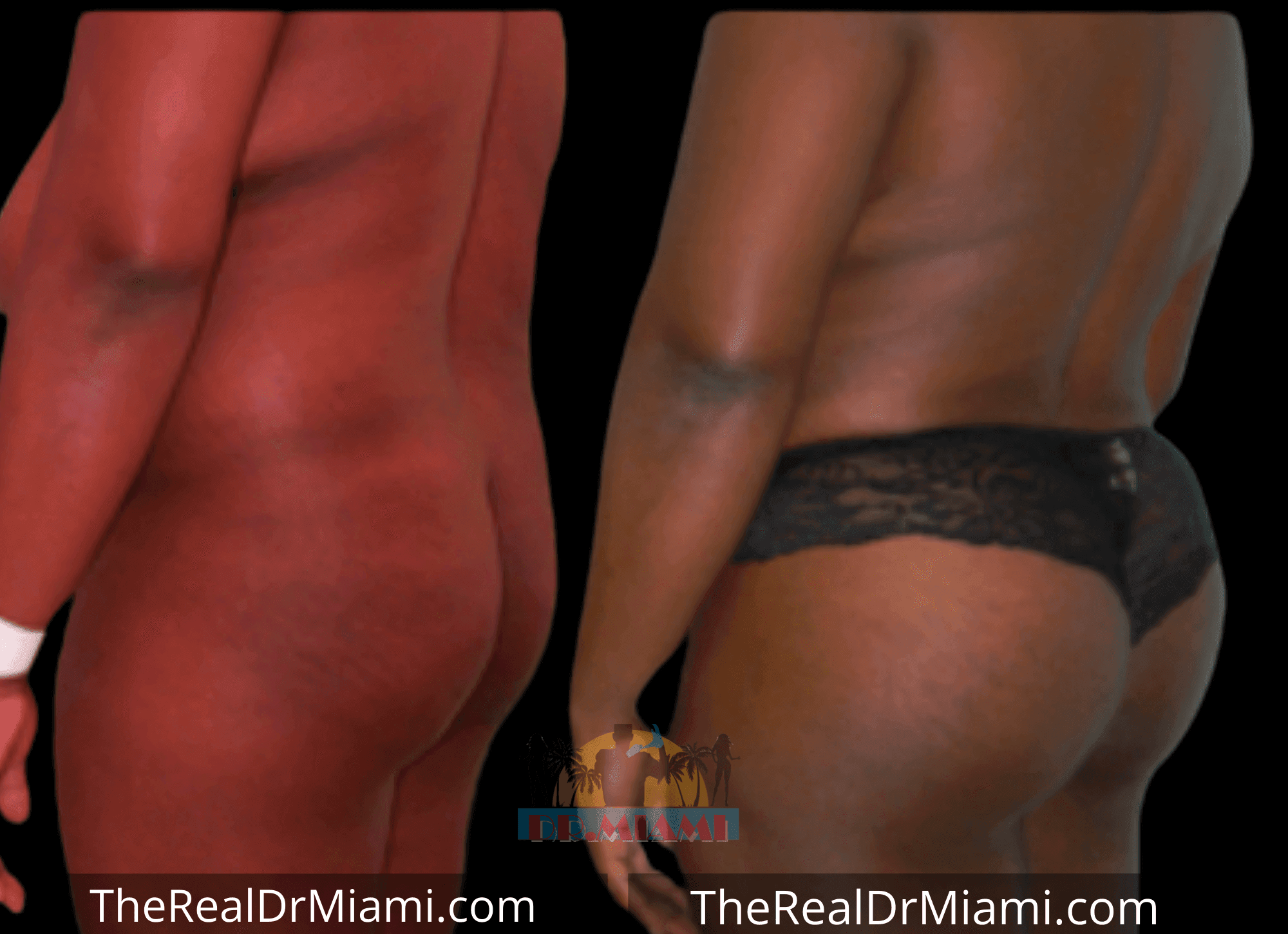 Before-and-after views for Brazilian Butt Lift, Case 49.