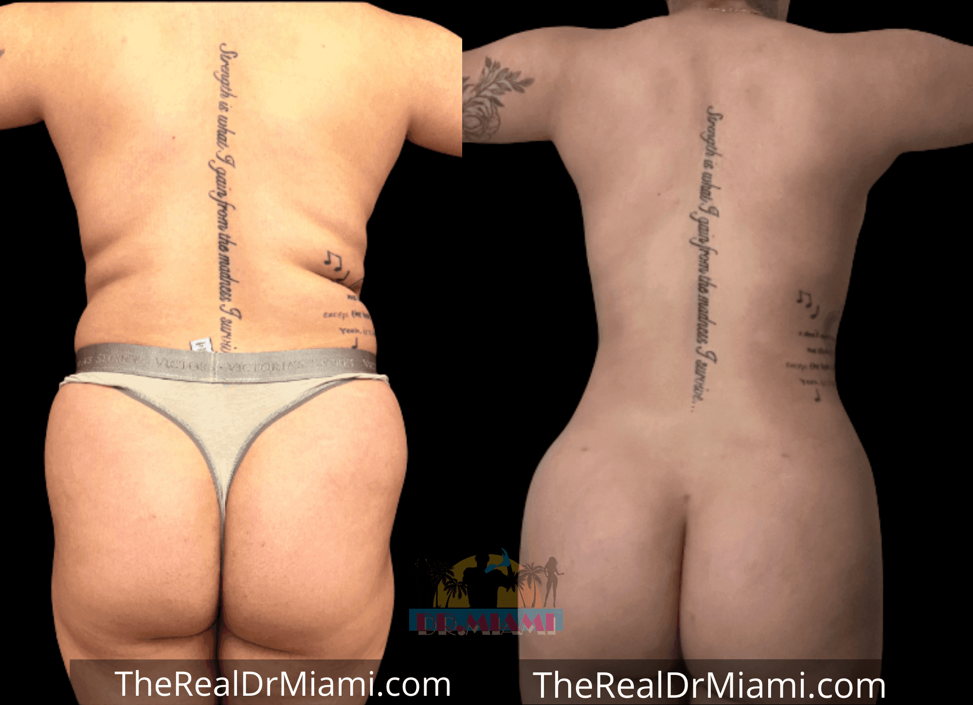 Before-and-after views for Brazilian Butt Lift, Case 84.
