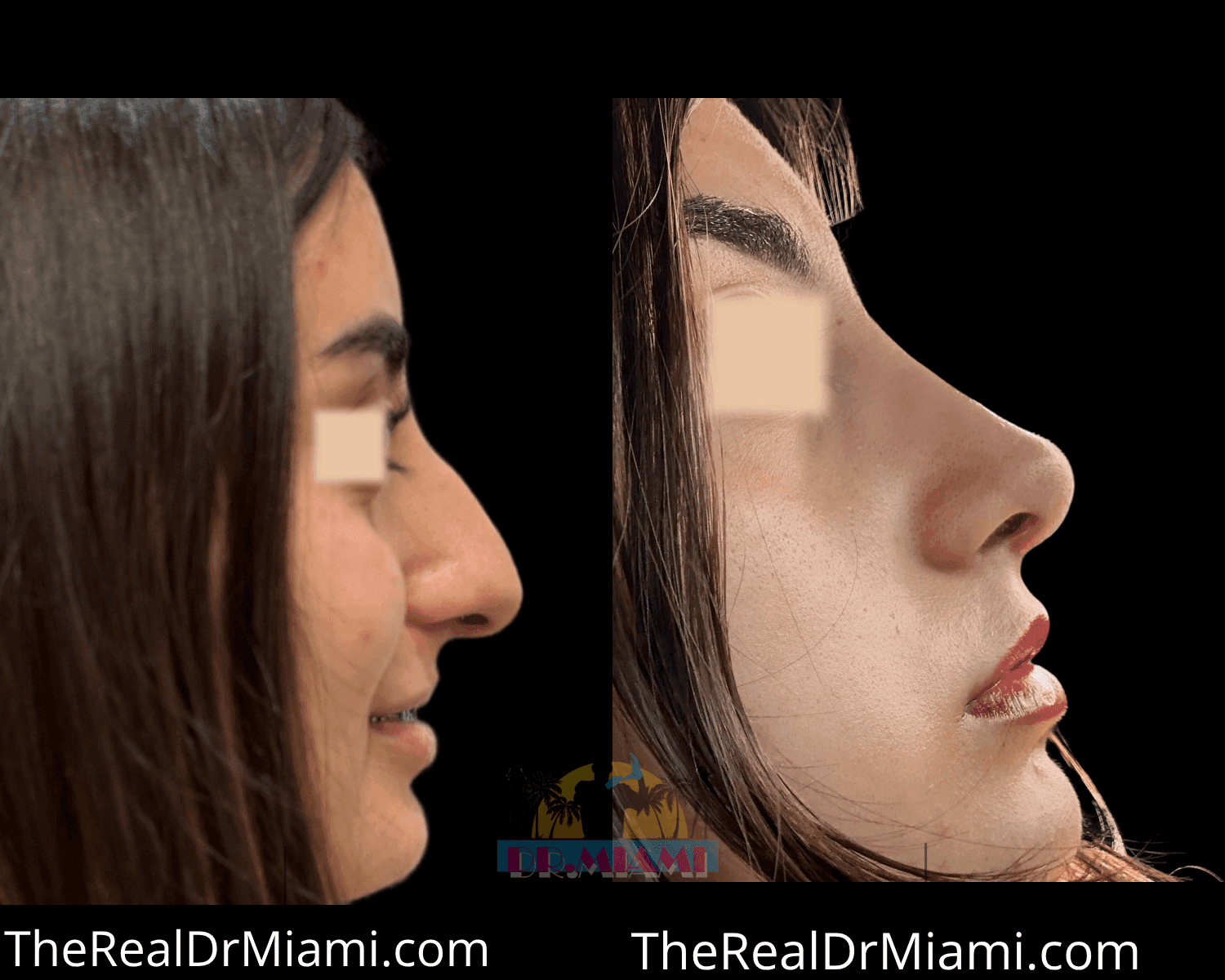 Before-and-after views for Rhinoplasty, Case 27.