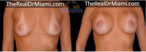 Before-and-after views for Breast Augmentation, Case 121.