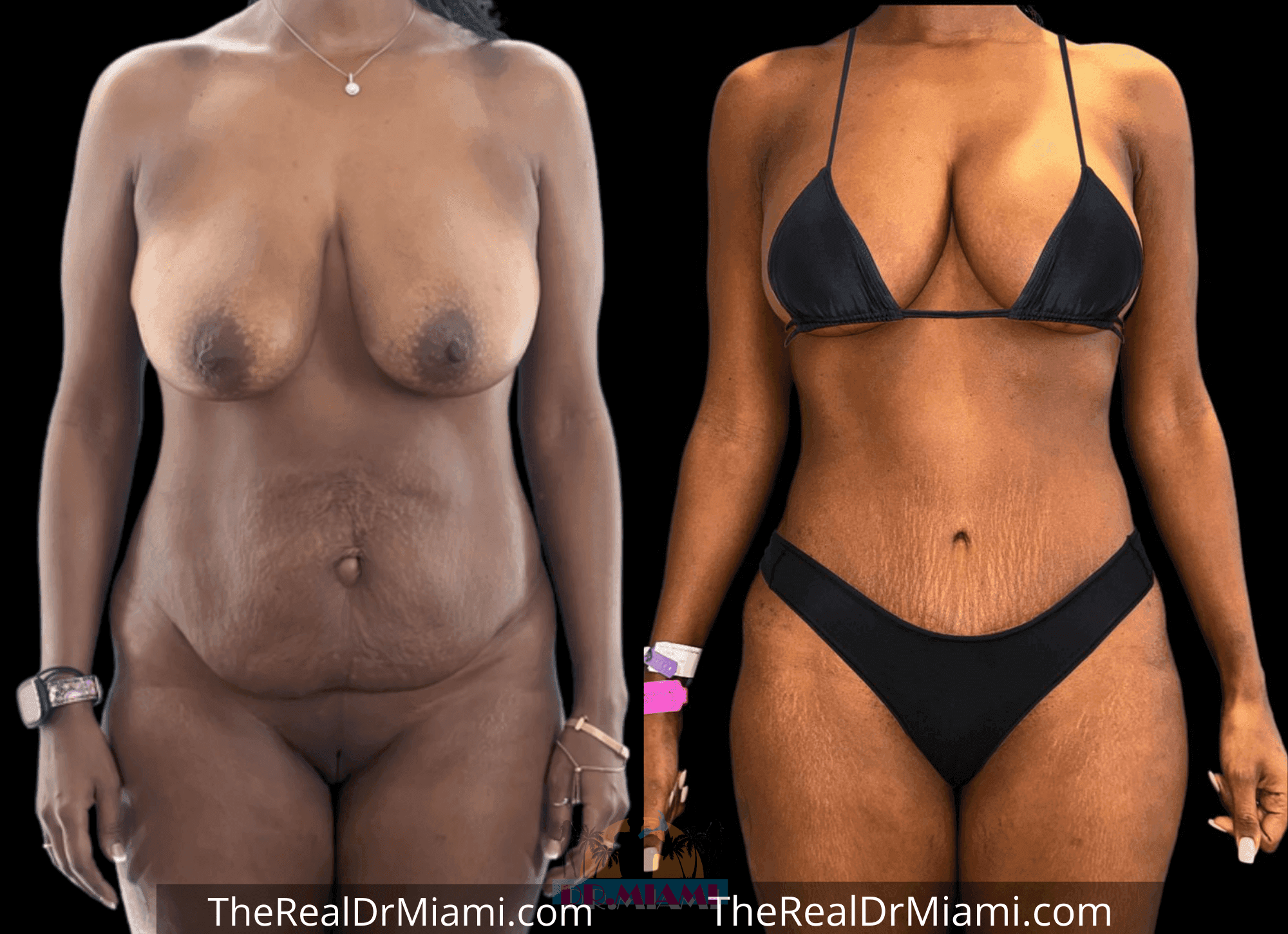 Before-and-after views for Mommy Makeover, Case 80.