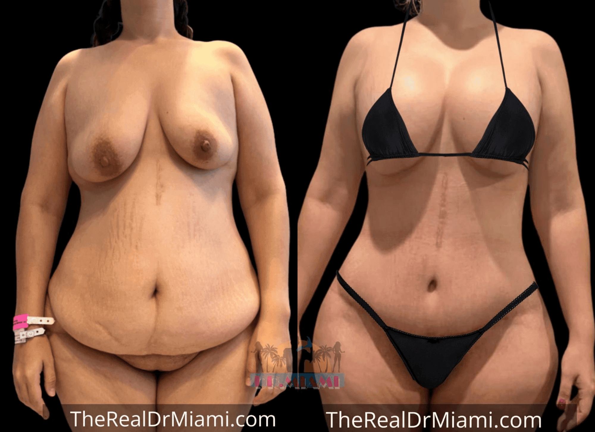 Before-and-after views for Mommy Makeover, Case 44.