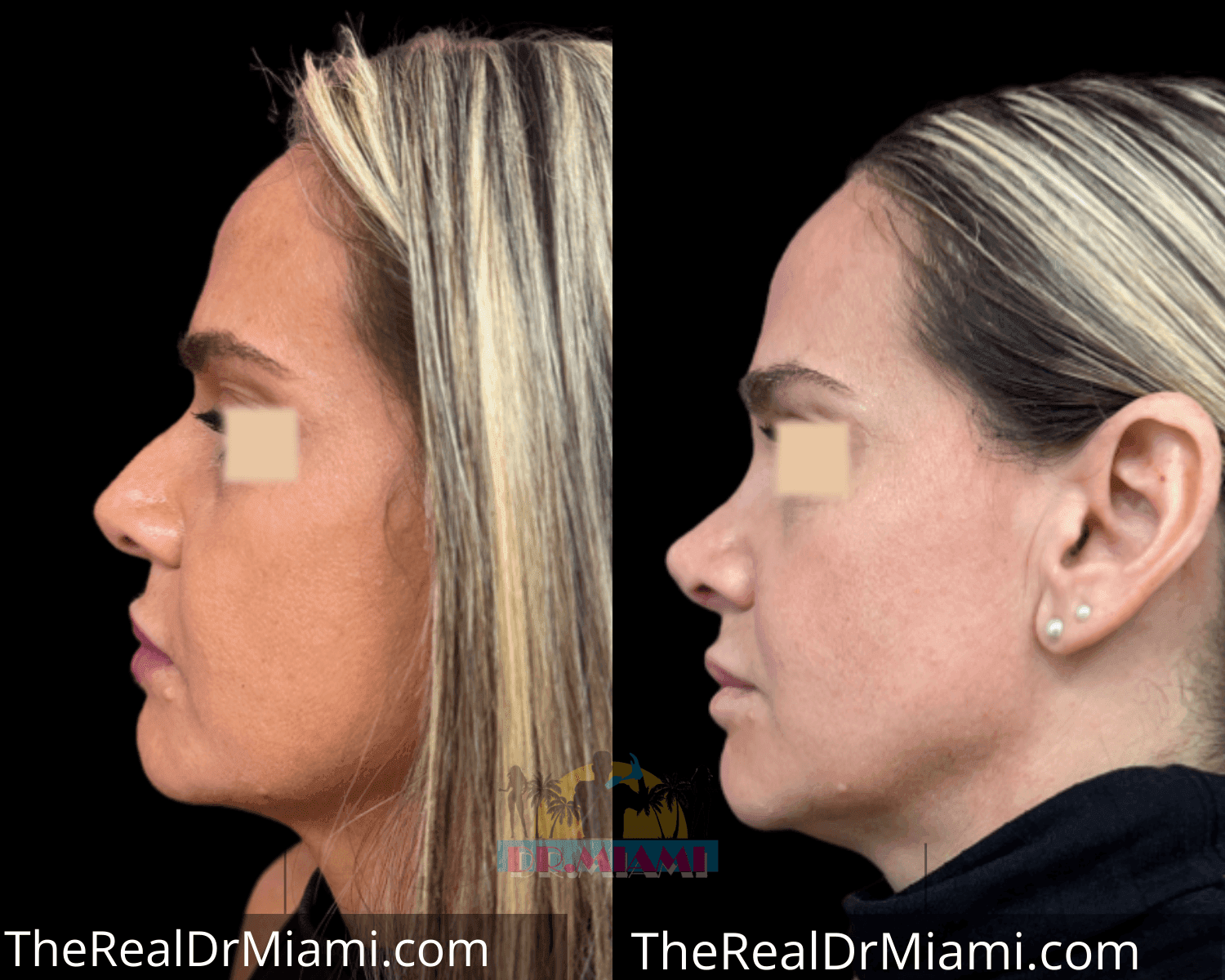 Before-and-after views for Rhinoplasty, Case 54.