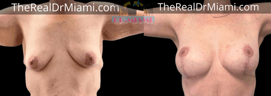 Before-and-after views for Breast Lift, Case 19.