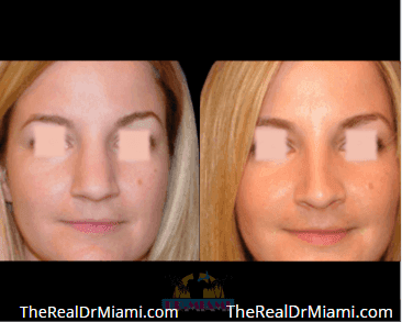 Before-and-after views for Rhinoplasty, Case 103.
