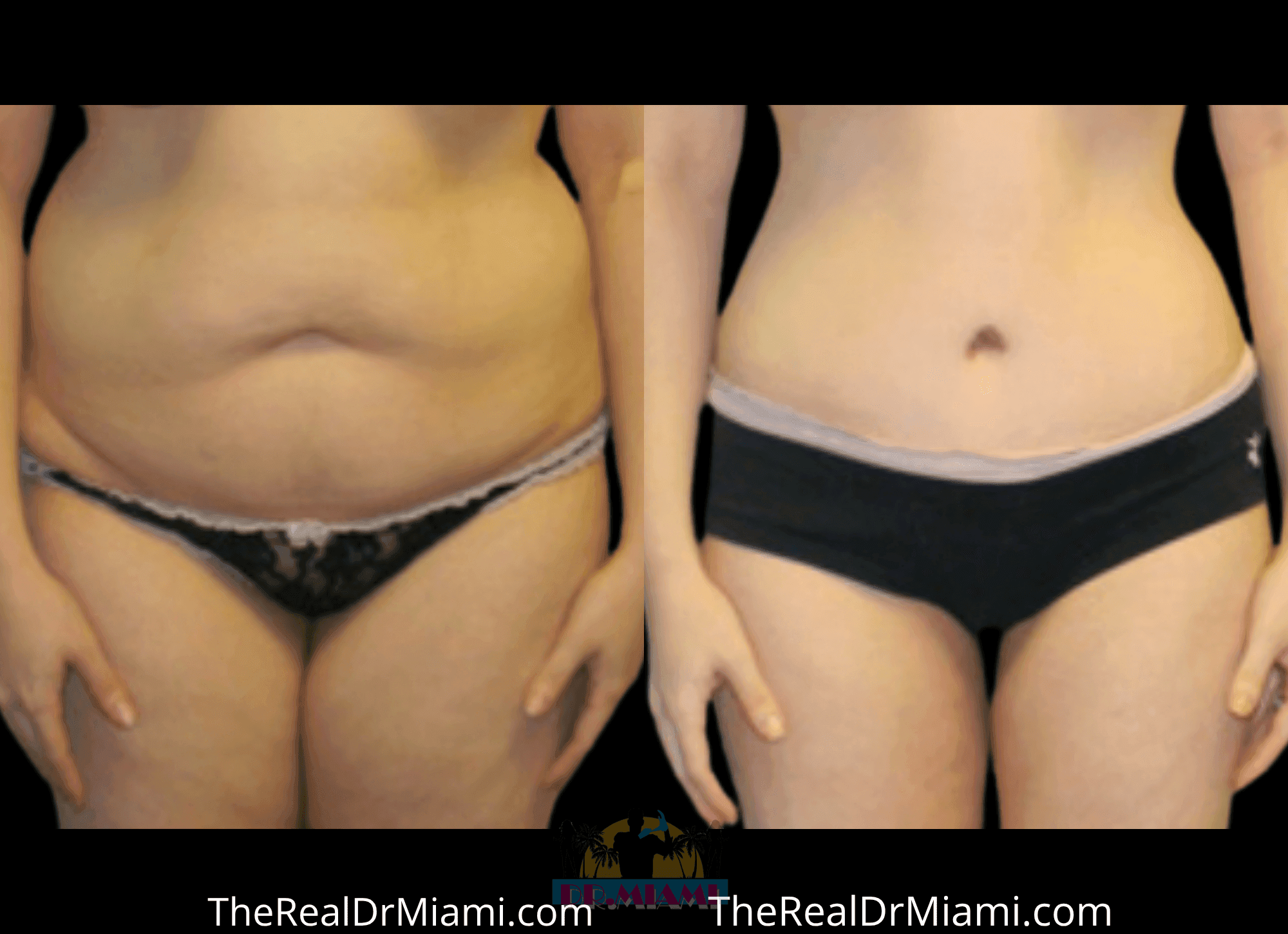 Before-and-after views for Tummy Tuck, Case 99.