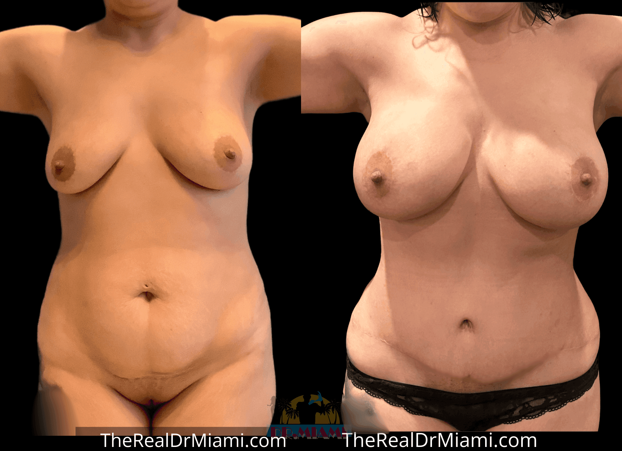 Before-and-after views for Mommy Makeover, Case 13.